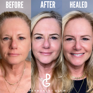 Healing Process: What to Expect After Your Permanent Eyebrow Treatment